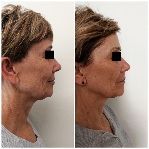 Facial rejuvenation Photo